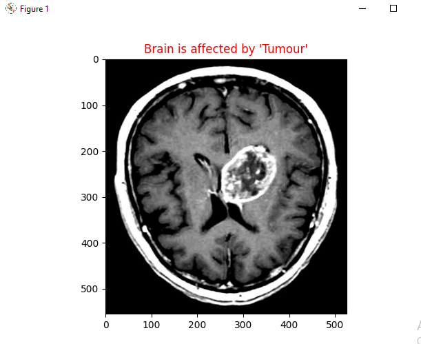 Brain
